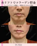 糸リフト before画像 サムネイル用