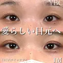 【🍇YBC式クイックアイ🍇】 before画像 サムネイル用