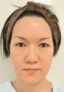 再生医療(全顔面脂肪吸引＆脂肪注入) before画像 サムネイル用