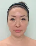再生医療(顔面脂肪吸引＆脂肪注入) before画像 サムネイル用