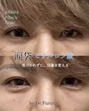 涙袋ヒアルロン酸 before画像 サムネイル用