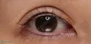 【30代女性・ハム目を改善して睫毛のキワを見せたい！！】睫毛上皮膚切開（7日後・抜糸時） before画像 サムネイル用