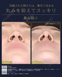 【20代女性・鼻の丸みスッキリ】鼻尖縮小術（1ヶ月後） 30日後 サムネイル用