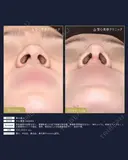 【20代女性・鼻の丸みスッキリ】鼻尖縮小術（1ヶ月後） 30日後 サムネイル用