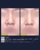 【20代女性・鼻の丸みスッキリ】鼻尖縮小術（1ヶ月後） 30日後 サムネイル用