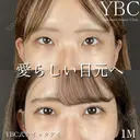 【🧁涙袋ヒアルロン酸🧁】 after画像 サムネイル用