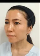 再生医療(顔面脂肪注入)+埋没 after画像 サムネイル用