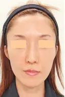 再生医療(顔面脂肪注入) after画像 サムネイル用