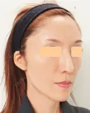 再生医療(顔面脂肪注入) after画像 サムネイル用