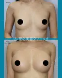 【20代女性】ハイブリット豊胸術（1ヶ月後） before画像 サムネイル用