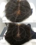 プルリアルヘアデンシティ after画像 サムネイル用