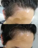プルリアルヘアデンシティ after画像 サムネイル用