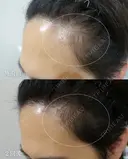 プルリアルヘアデンシティ after画像 サムネイル用