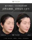 人中短縮（鼻柱切開）・鼻翼縮小・鼻翼挙上・貴族組織移植 before画像 サムネイル用