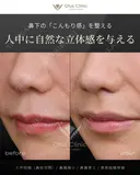 人中短縮（鼻柱切開）・鼻翼縮小・鼻翼挙上・貴族組織移植 before画像 サムネイル用
