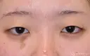 【10代女性・自然な目元に】二重埋没法：ダブルノット法（1ヶ月後） before画像 サムネイル用