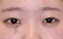 【10代女性・自然な目元に】二重埋没法：ダブルノット法（1ヶ月後） 30日後 サムネイル用