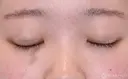 【10代女性・自然な目元に】二重埋没法：ダブルノット法（1ヶ月後） 30日後 サムネイル用