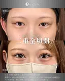 二重全切開 after画像 サムネイル用
