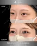 二重全切開 before画像 サムネイル用