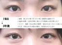 目頭切開法 1080日後 サムネイル用