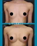 【20代女性】バッグによる豊胸術（MotivaErgonomix2 180cc）（3ヶ月後） 90日後 サムネイル用