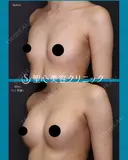 【20代女性】バッグによる豊胸術（MotivaErgonomix2 180cc）（3ヶ月後） 90日後 サムネイル用