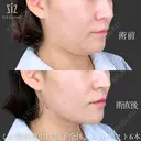 【ミニ脂肪吸引】切らずに20分 before画像 サムネイル用