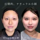 Wing小顔女神脂肪吸引 before画像 サムネイル用
