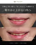 鼻柱切開人中短縮（MIX切開）・鼻翼縮小・鼻翼挙上・貴族組織移植・口角挙上（全層法）・外側人中短縮 before画像 サムネイル用