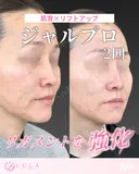 ジャルプロスーパーハイドロ after画像 サムネイル用