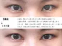 目頭切開法 30日後 サムネイル用