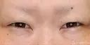【30代女性・たれ目に】目尻切開法＋グラマラスライン（たれ目）形成切開法（11ヶ月後） before画像 サムネイル用