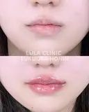 Cカールリップ　ボルベラ　 before画像 サムネイル用