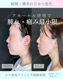 アキーセル併用小顔脂肪吸引　ホホ下＋フェイスライン＋アゴ下＋エラ下 before画像 サムネイル用