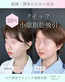 アキーセル併用小顔脂肪吸引　ホホ下＋フェイスライン＋アゴ下＋エラ下 before画像 サムネイル用