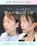 アキーセル併用小顔脂肪吸引　ホホ下＋フェイスライン＋アゴ下＋エラ下 after画像 サムネイル用