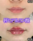 Cカールリップ after画像 サムネイル用