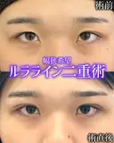 二重埋没（ルラライン２点） before画像 サムネイル用