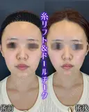 ルラリフト+ドールチーク before画像 サムネイル用
