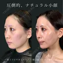 オンダリフト＋糸リフト before画像 サムネイル用