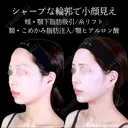 頬・顎下脂肪吸引/糸リフト/額・こめかみ脂肪注入/エラボトックス/顎ヒアルロン酸 before画像 サムネイル用