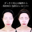 頬・顎下脂肪吸引/糸リフト/額・こめかみ脂肪注入/エラボトックス/顎ヒアルロン酸 90日後 サムネイル用