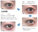 目頭切開法 30日後 サムネイル用