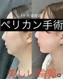 ペリカン手術 after画像 サムネイル用