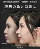 肋軟骨鼻フル after画像 サムネイル用
