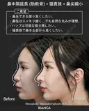 肋軟骨鼻フル after画像 サムネイル用