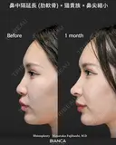 肋軟骨鼻フル after画像 サムネイル用