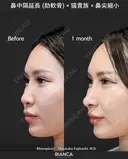 肋軟骨鼻フル after画像 サムネイル用