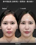 肋軟骨鼻フル after画像 サムネイル用